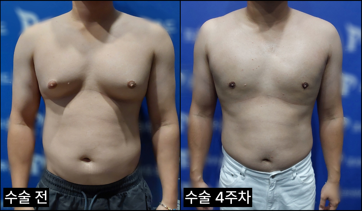여유증 후기 사진