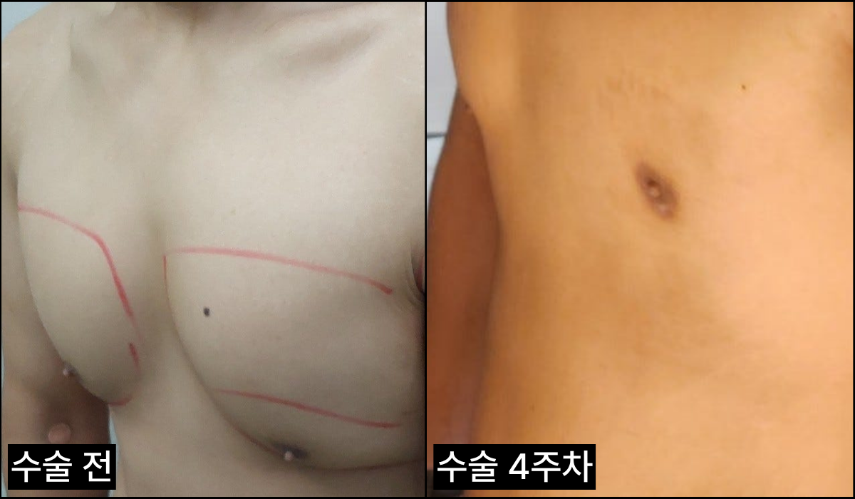 여유증 후기 사진