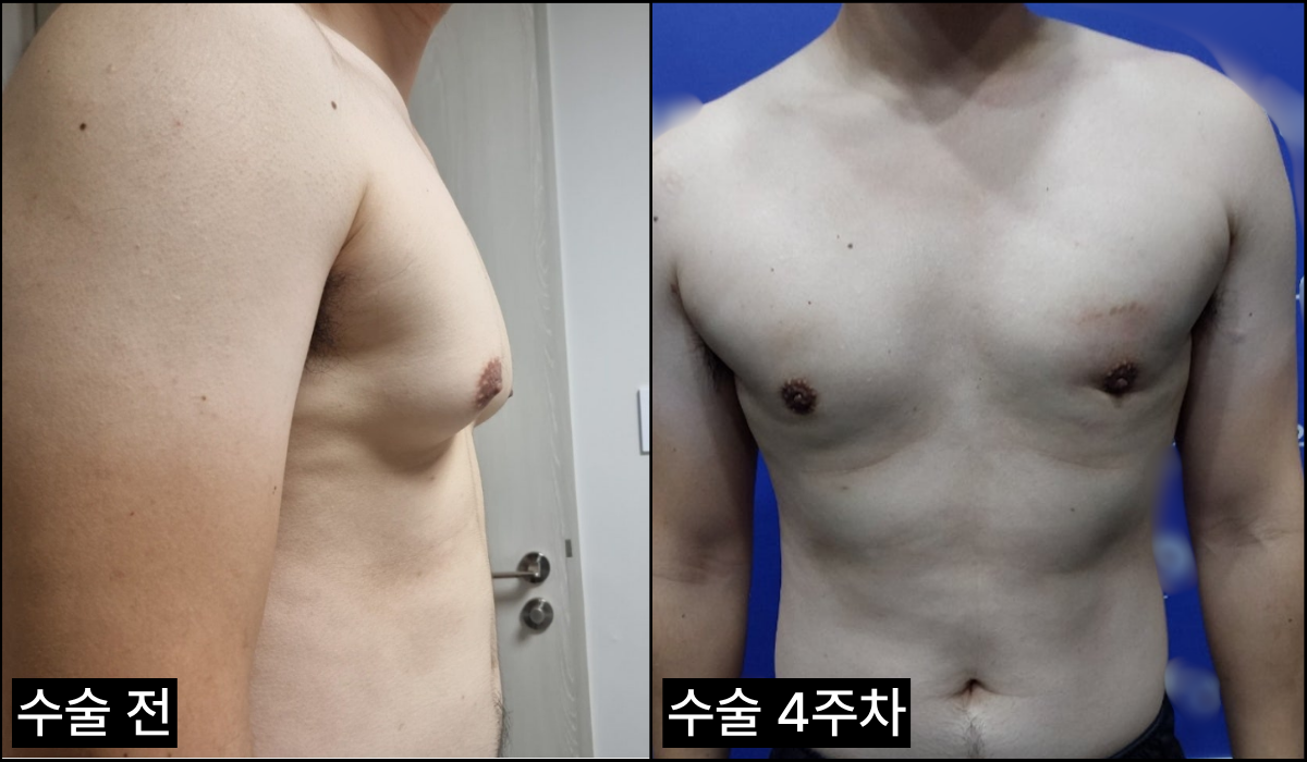 여유증 후기 사진