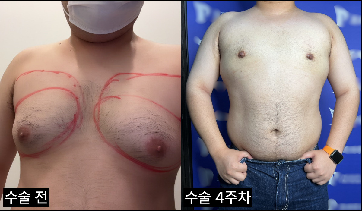 여유증 후기 사진